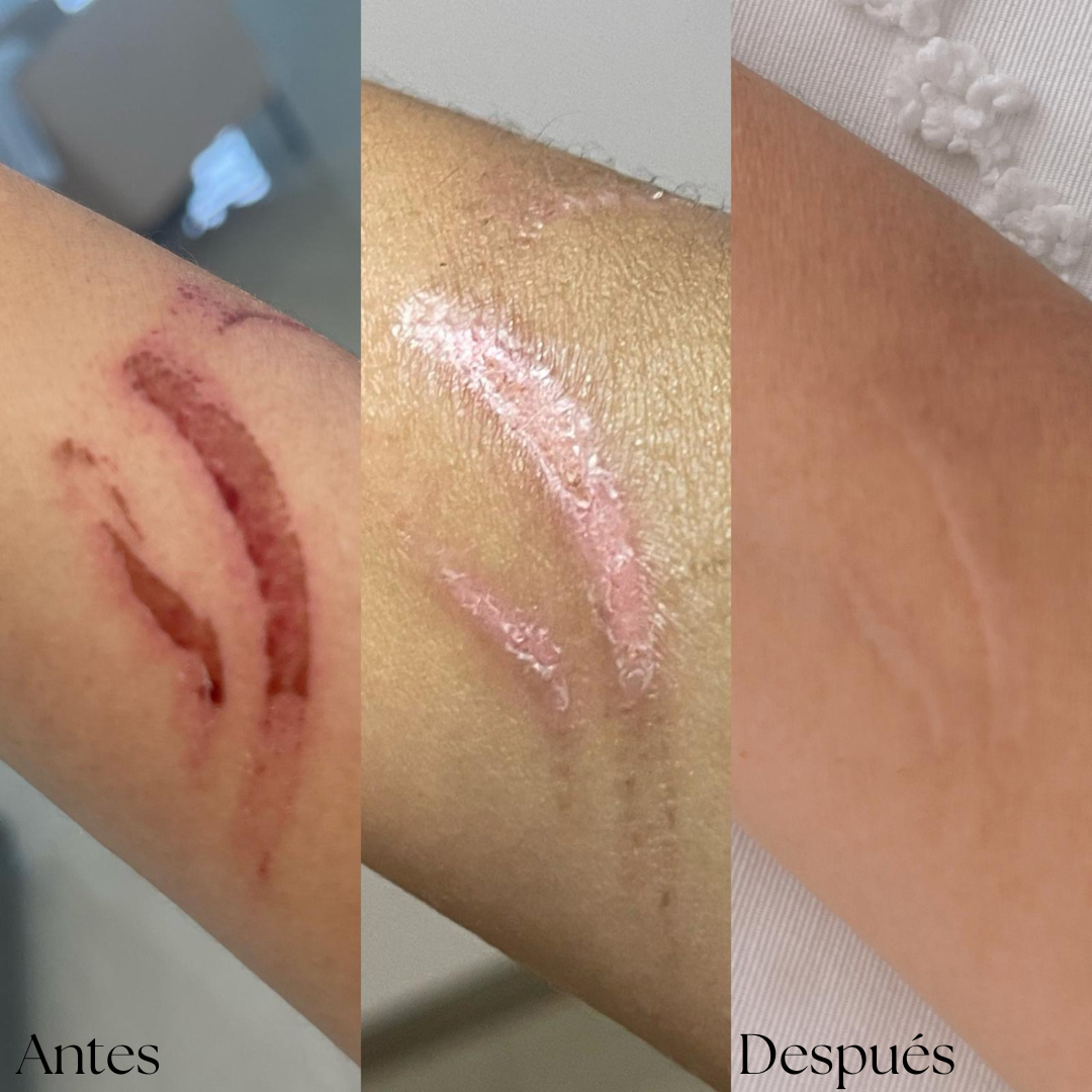 Aceite Reparador Cicatrices y Estrías